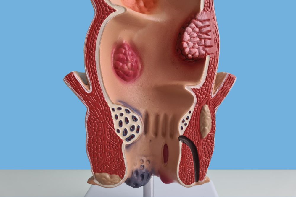 Laserowe usuwanie hemoroidów - skuteczne i bezbolesne rozwiązanie