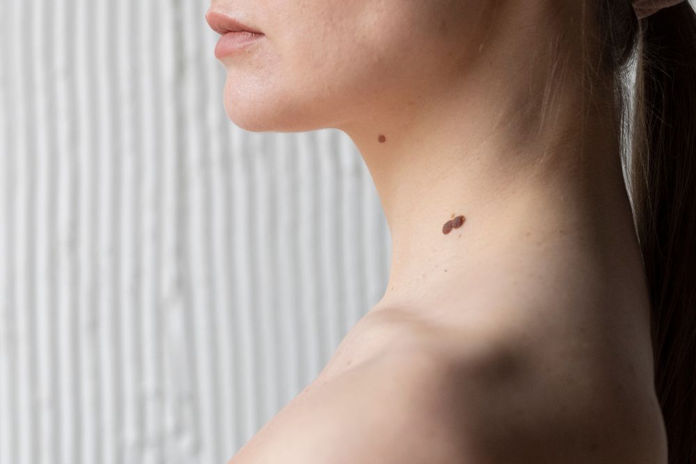 Usuwanie znamion laserem - co musisz wiedzieć?