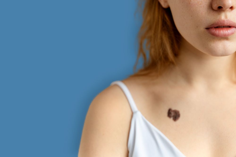 Usuwanie znamion, włókniaków, pieprzyków Poznań: laserowa precyzja