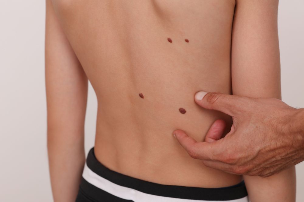 Czy każde znamię skórne trzeba usuwać? Kiedy jest to konieczne?